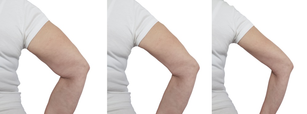 3 Easy Exercises to Quickly Transform Flabby Arms in 30 ...
